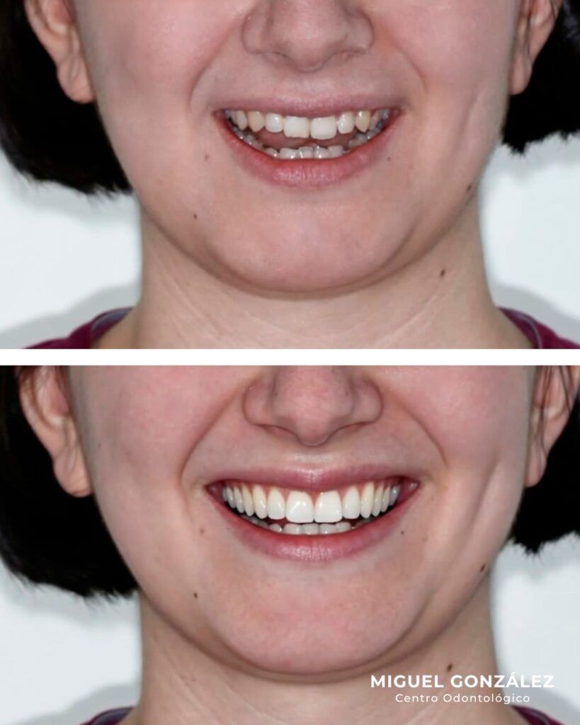 Caso real de estética dental en Oviedo: sonrisa de una paciente antes y después del tratamiento