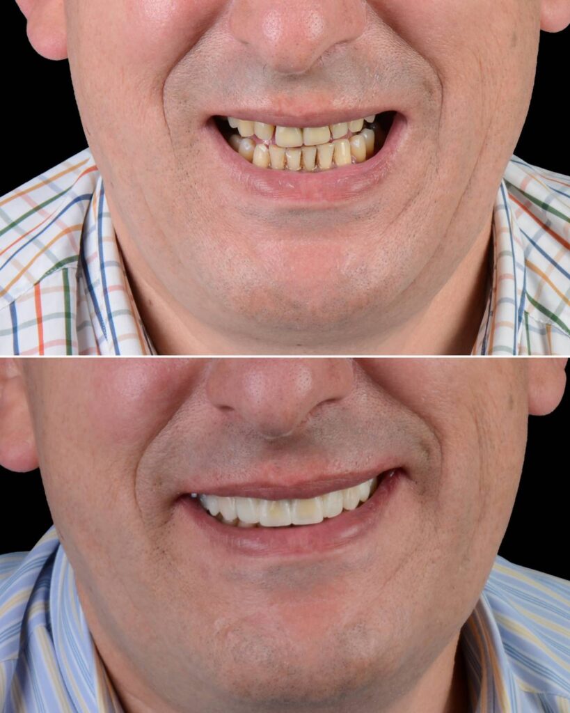 Caso de desgaste dental tratado con carillas en el Centro Odontológico Miguel González, Oviedo.