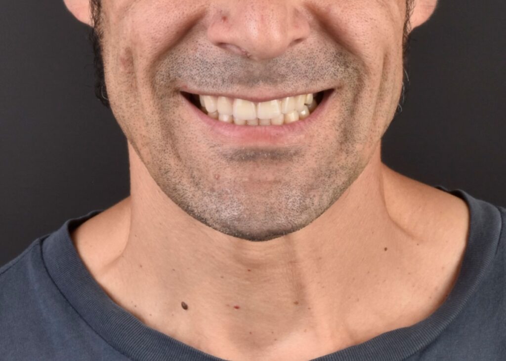 Después de Carillas dentales en Oviedo - Clínica Dental Miguel González 1