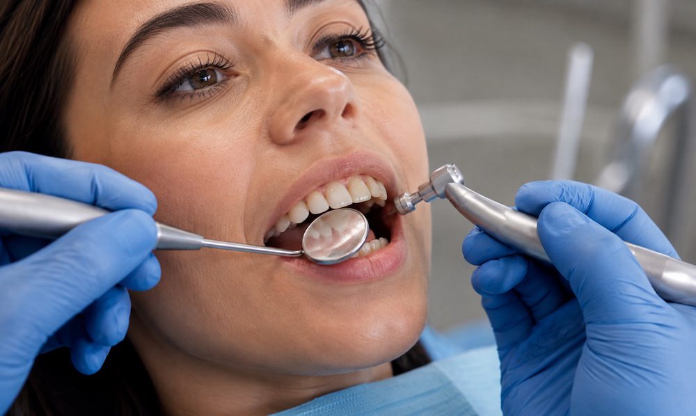 Limpieza-dental-en-Oviedo-Centro-Odontologico-Miguel-Gonzalez, Asturias