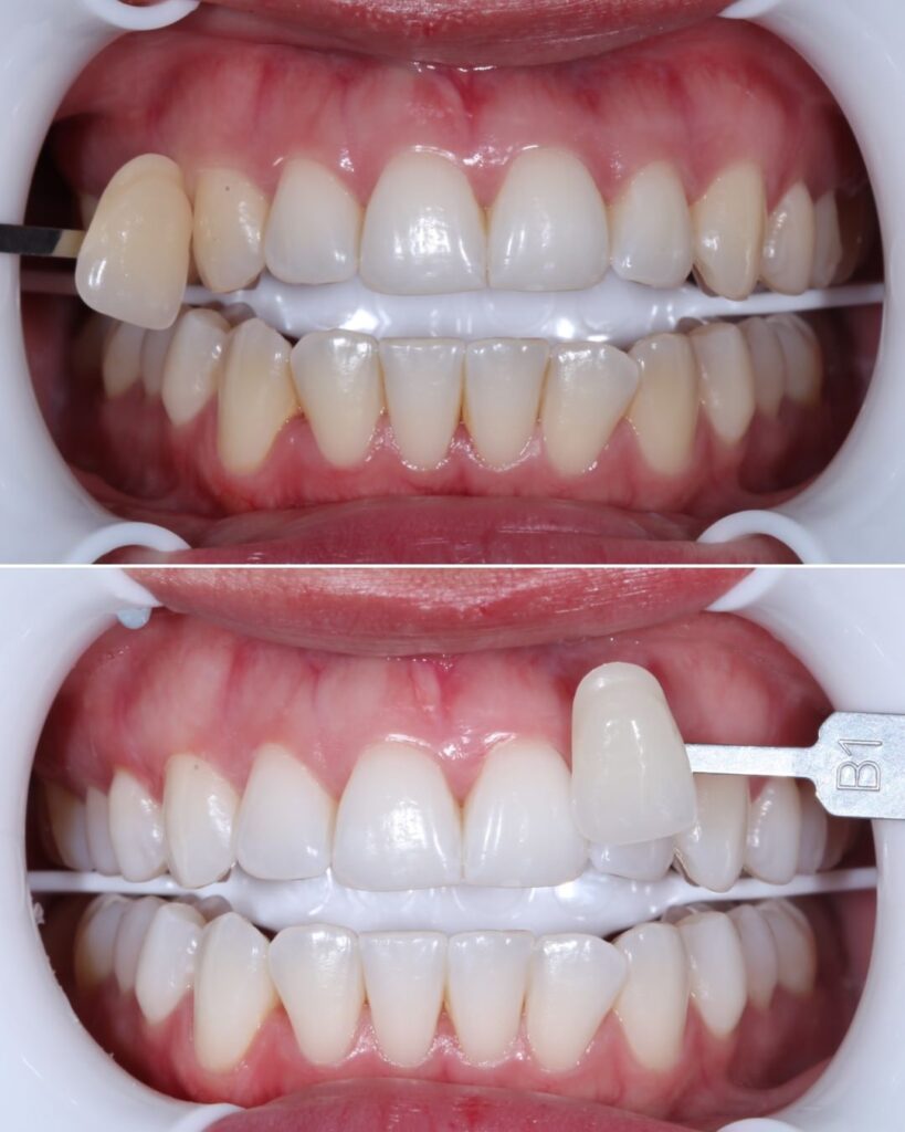 Antes-despues-Blanqueamiento-dental-en-Oviedo-con-un-plan-a-tu-medida-Centro-Odontologico-Miguel-Gonzalez-2